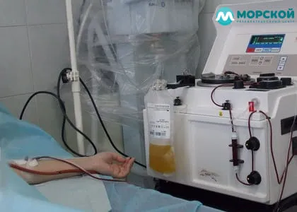 Чем полезен плазмаферез Пациент на процедуре плазмафереза